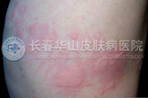 荨麻疹图片