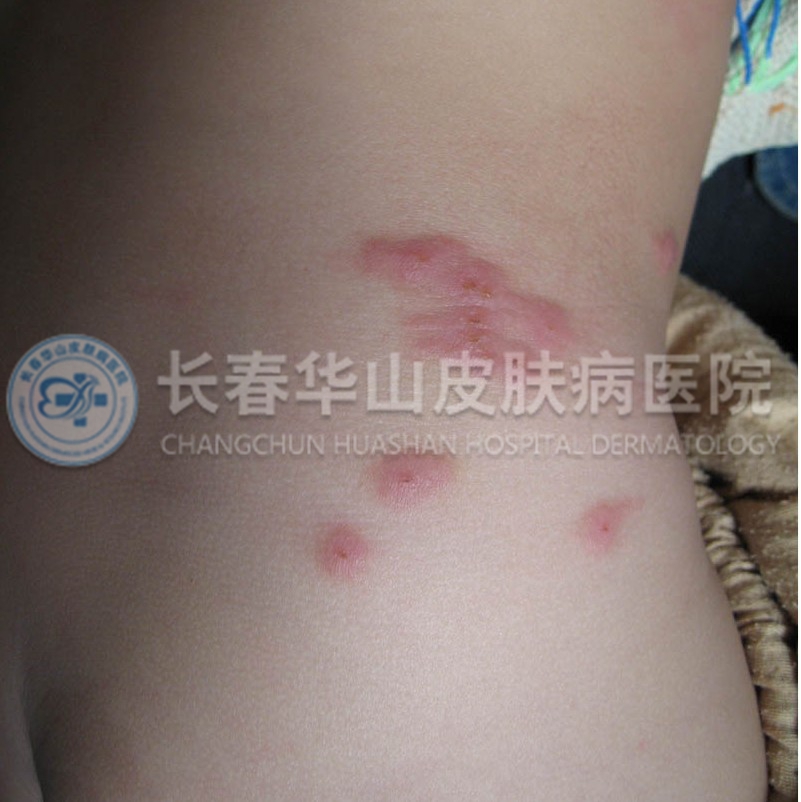 荨麻疹图片