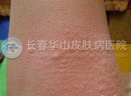 荨麻疹图片