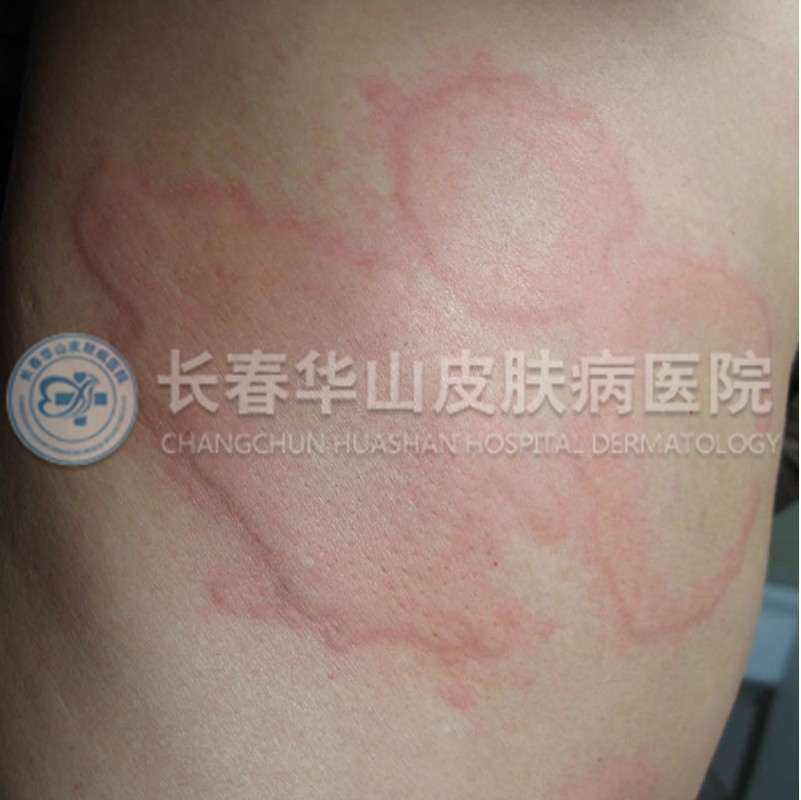 荨麻疹图片