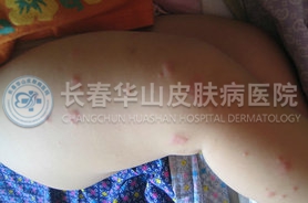 荨麻疹图片