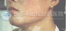 白癜风图片