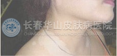 白癜风图片