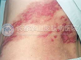 带状疱疹症状表现