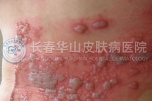 疱疹