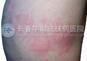荨麻疹的症状