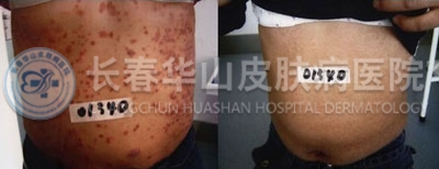荨麻疹治疗前后对比