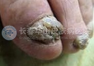 灰指甲