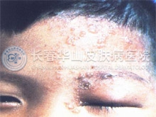 眼睑带状疱疹症状表现