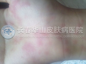 皮炎图片