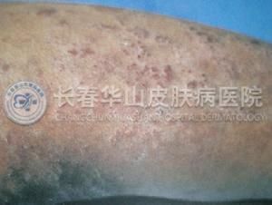 皮炎图片