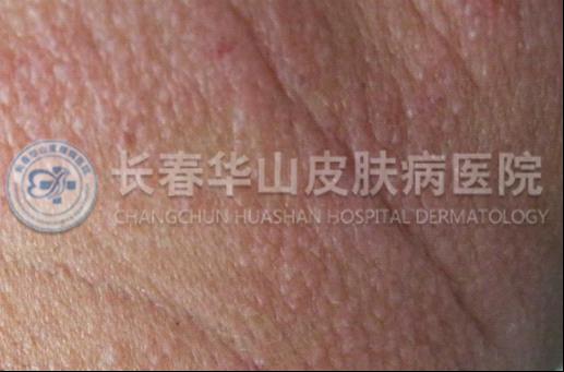 皮炎图片