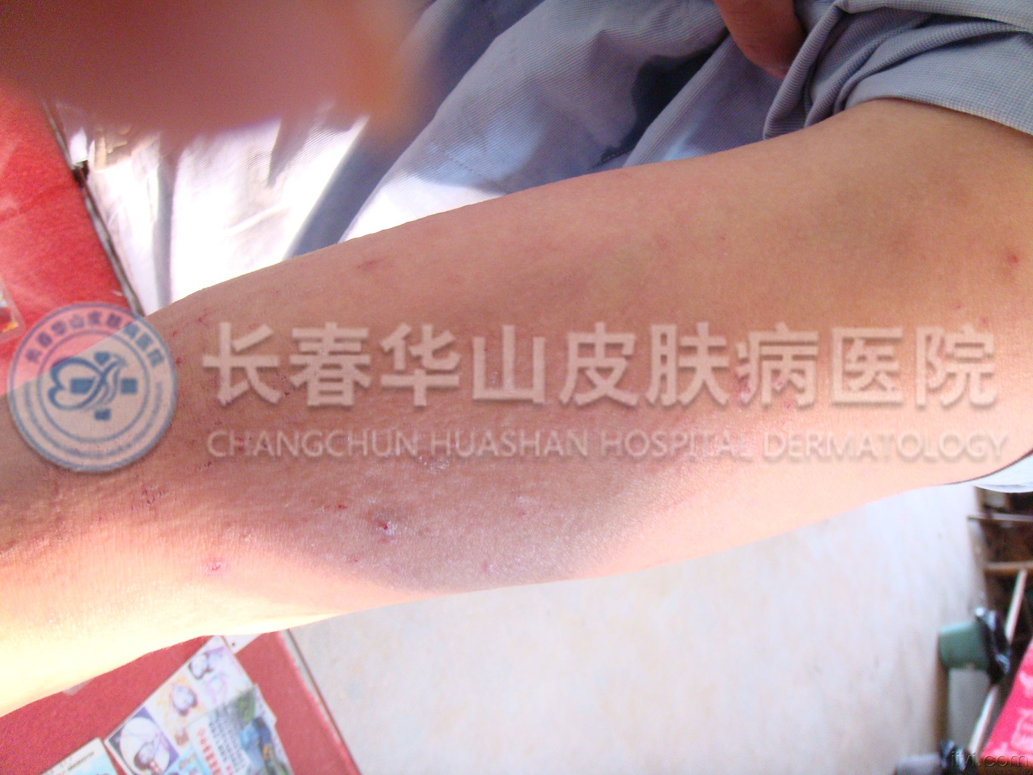 皮炎图片
