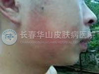 换季性皮肤过敏