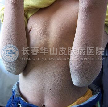鱼鳞病怎样保养效果最好?