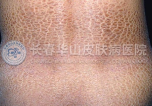 预防鱼鳞病的几个措施不能少