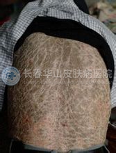 鱼鳞病的诊断依据是什么