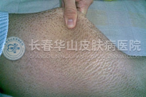 鱼鳞病有哪些检查方法
