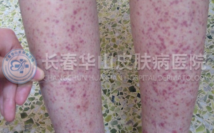 过敏性紫癜诊断要点