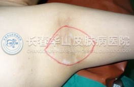 腋臭症状图