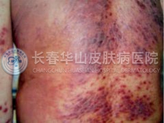 神经性皮炎症状表现