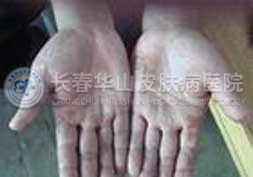 皮肤过敏症状