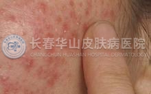 患有脂溢性皮炎应该注意什么