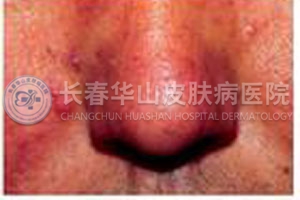 酒糟鼻症状图片
