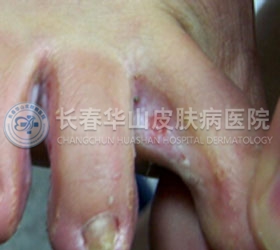 手足癣传染吗