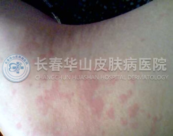 荨麻疹是怎么引起的