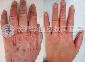 湿疹治愈案例