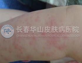湿疹症状表现