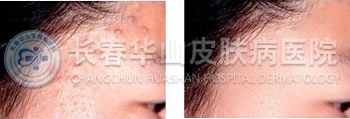 脂溢性皮炎治愈案例