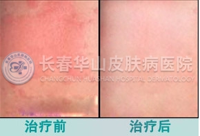 荨麻疹治疗前后对比图片