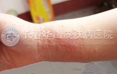 湿疹是怎么引起的