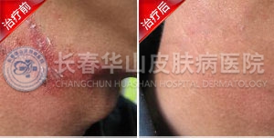 湿疹治愈案例
