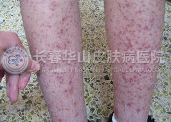 紫癜的症状