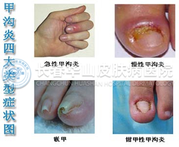 甲沟炎的症状 看图识病更清楚