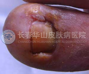 慢性甲沟炎