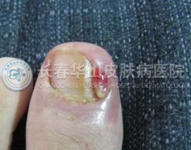 甲沟炎症状图片