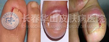 甲沟炎的治疗费用是多少
