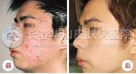 三角区上的痘痘怎么去除