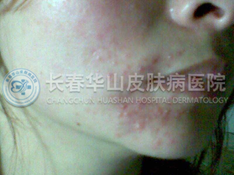 有皮肤过敏怎么办