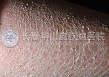 鱼鳞病的治疗方法是什么