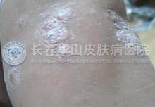 鱼鳞病患者需要注意什么