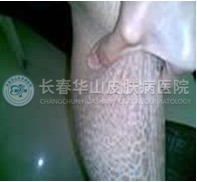 鱼鳞病有哪些治疗方法