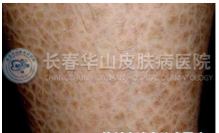 患了鱼鳞病怎么办