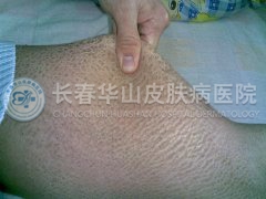 鳞病的常见类型有哪几种