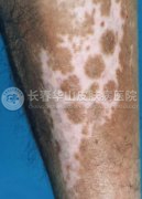 鱼鳞病症状如何缓解