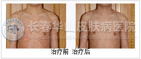 荨麻疹治疗前后对比